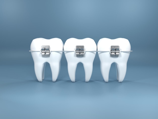 Dental implants surgery 3d rendering