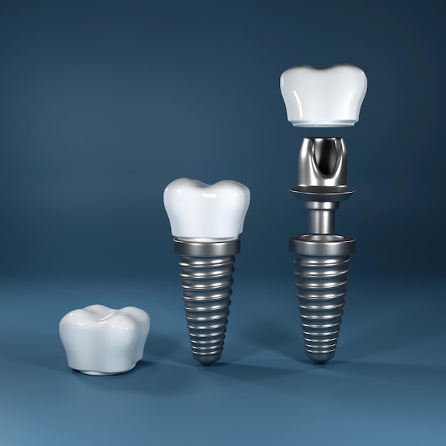 Dental implants surgery 3d rendering