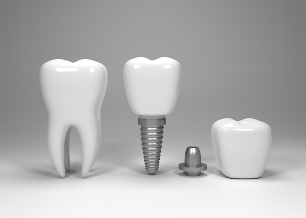 Dental implants surgery 3d rendering