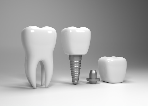 歯科インプラント手術の 3 d レンダリング