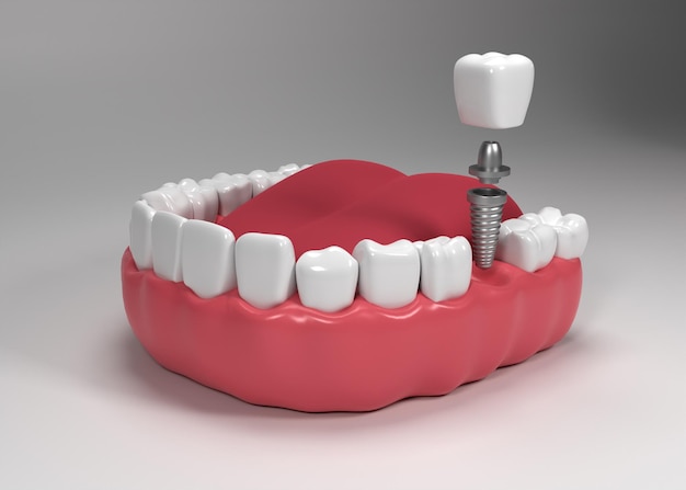 Dental implants surgery 3d rendering