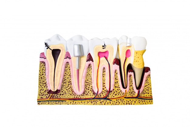 Dental model for patient education