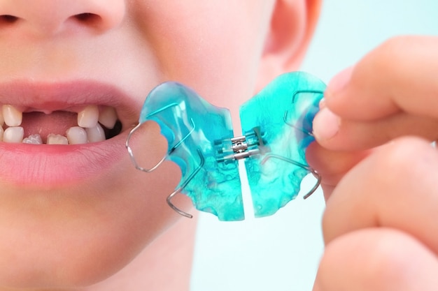 Dental plate. Expansion of the jaw in a child. A plate to heaven. There is not enough room for the molars. Happy boy holding an orthodontic plate in his hands