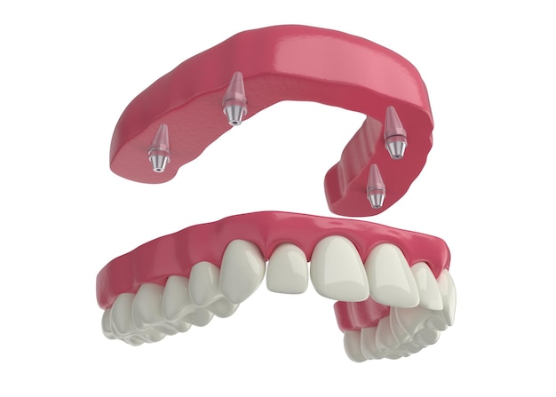 Photo dental prosthesis, 4 overdenture implants, upper arch, 3d render