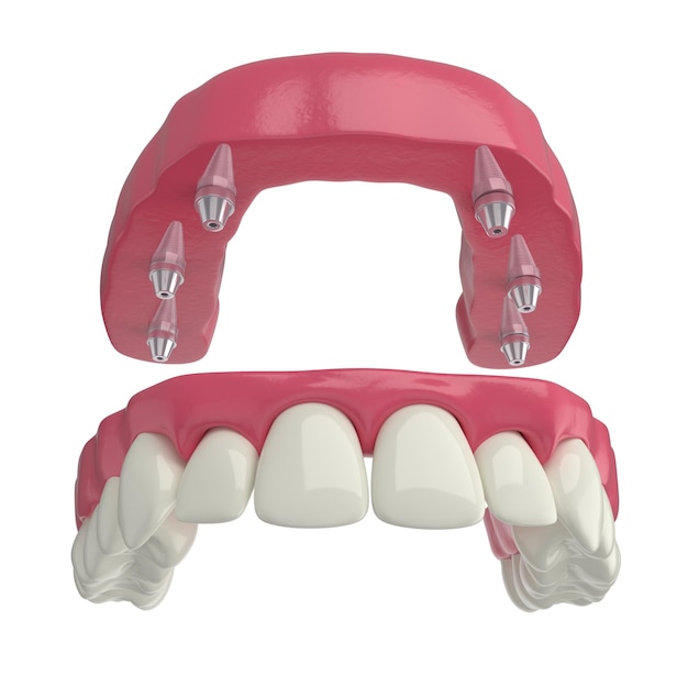 dental prosthesis, 6 overdenture implants, upper arch, 3d render