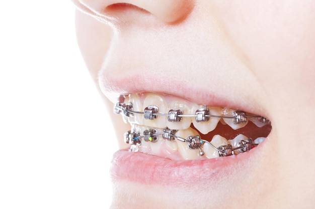 Photo dental steel braces on teeth close up