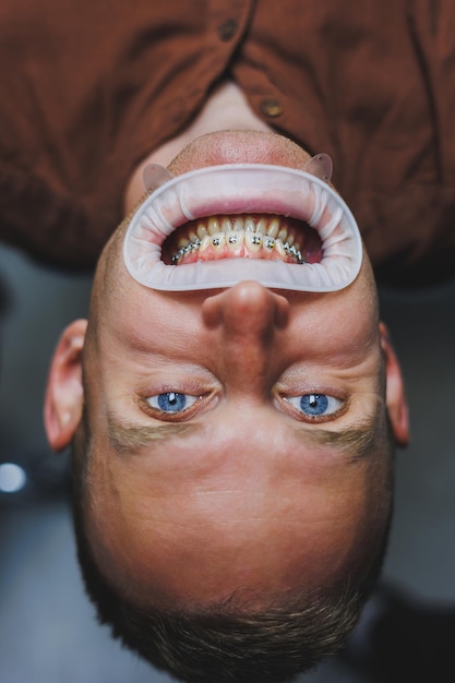 Dental treatment of teeth a young man at a dentist\'s\
appointment the doctor installs metal braces on the teeth closeup\
of teeth with braces