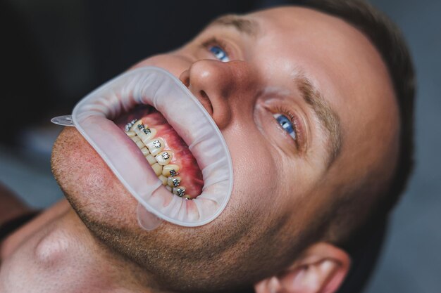 치아의 치과 치료 치과 의사의 약속에 젊은 남자 의사가 치아에 금속 교정기를 설치합니다 교정기가 있는 치아의 근접 촬영
