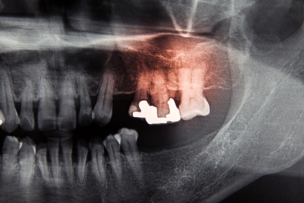 치과 치료를위한 치과 엑스레이 필름