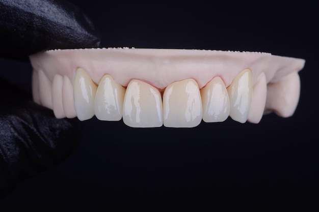 黒い手袋で塗装されたジルコニアの歯の冠 陶器の染料による単体歯の冠