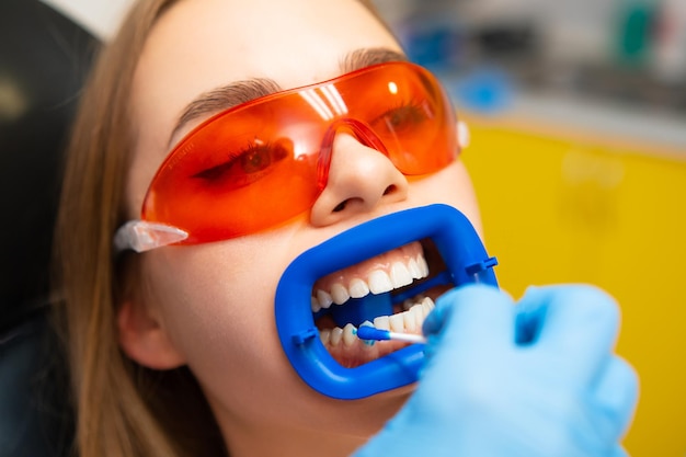 Dentist applies whitening gel to female patient wearing orange protective goggles teeth in the