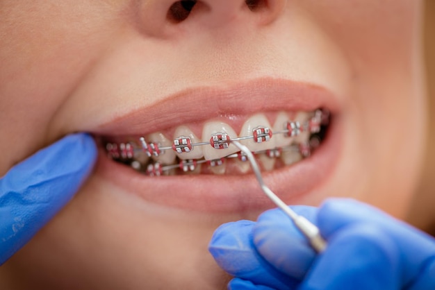 Dentist checking bracket at the braces on the female patient. Close-up. Real People.