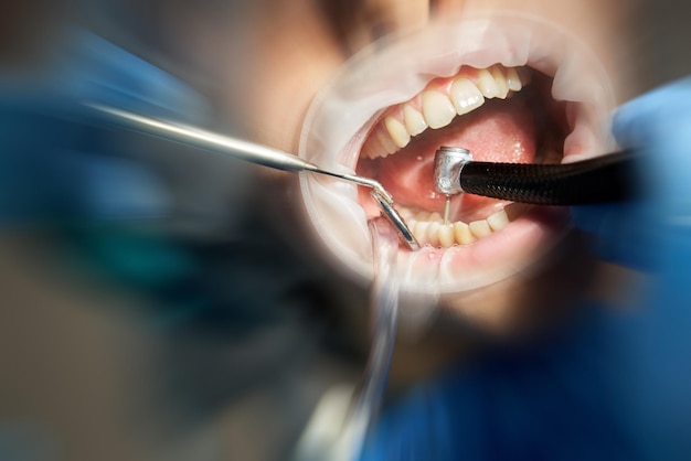 Dentist drilling tooth to male patient in dental chair with motion blur effect