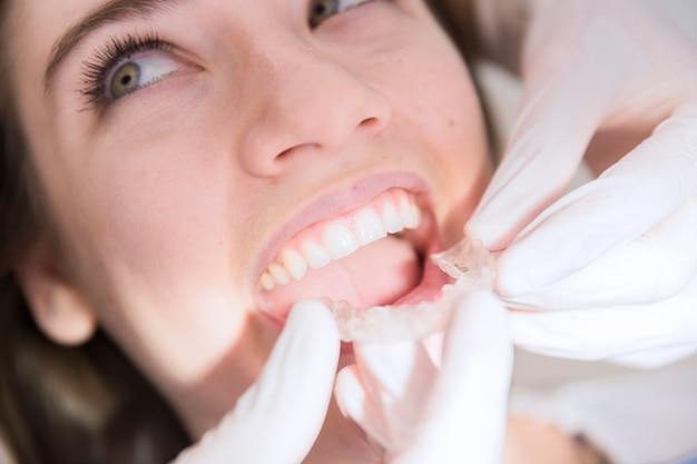 Mano del dentista che mette l'allineatore trasparente dei denti in denti del paziente