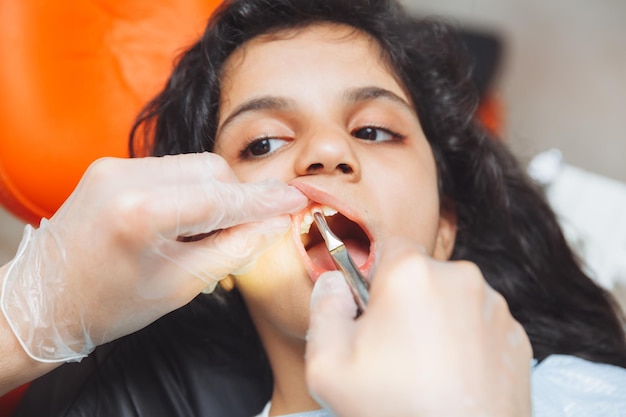 The dentist removes the tooth of a little girl with pliers painless tooth extractionpediatric dentistry