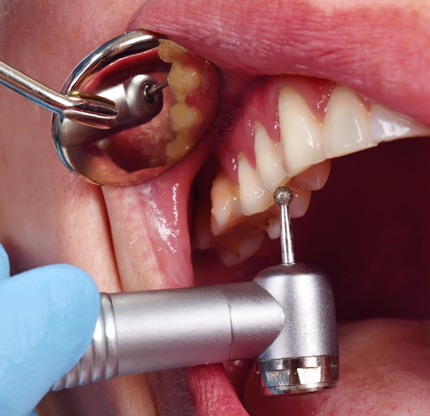 Dentist using dental drill