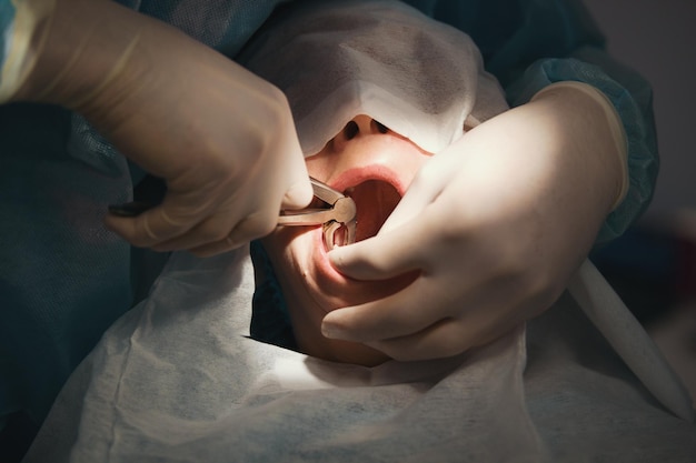 Dentist using surgical pliers to remove a decaying tooth in stomatology room, close up