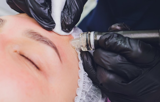 Dermabrasion girl's forehead instrumental cosmetology spa facial rejuvenation mechanical peeling skin