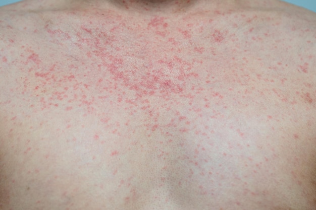 Malattia virale eruzione cutanea da dermatite con immunodeficienza sul corpo di un giovane asiatico adulto, graffio con prurito, virus del morbillo, esantema virale