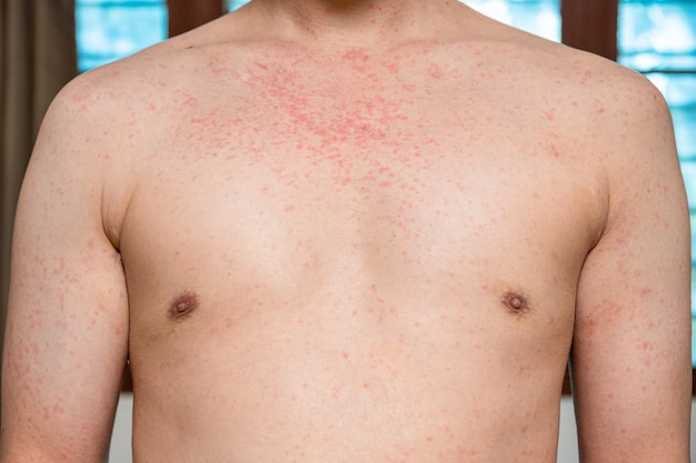 Dermatitis rash viral disease with immunodeficiency on body of\
young adult asian, scratch with itch, measles virus, viral\
exanthem