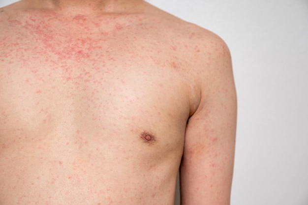 Dermatitis uitslag virale ziekte met immunodeficiëntie op het lichaam van jonge volwassen Aziatische kras met jeuk Mazelen Virus Viraal Exanthem