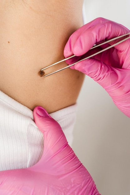 Dermatologist examines moles or birthmark of girl patient for revention of melanoma and skin cancer closeup Checking for benign moles Examination of skin neoplasm and lesions of young woman