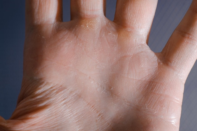 Dermatology healthcare and medicine concept dry sick cracked\
skin of palm of caucasian hand closeup skin disease macro\
photo