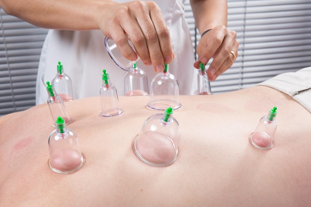 Photo detail of an acupuncture therapist removing a plastic globe in a cupping procedure