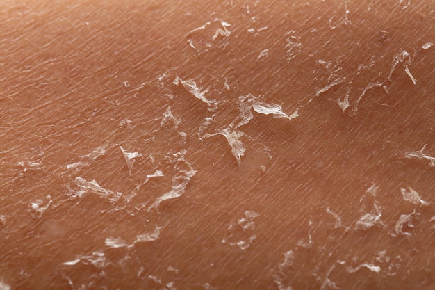 Photo detail of dry woman skin dehydration due to the sun's rays without sun protection