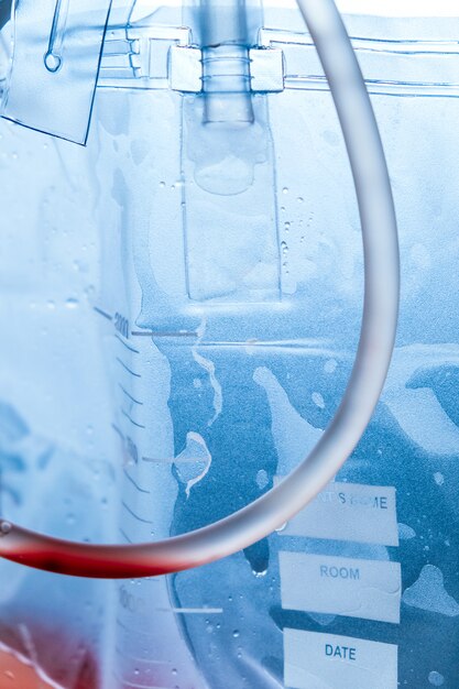 Detail image of Urine bag hanging beside the patient's bed with fluid and blood