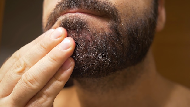 Detail van de kin van de man met seborrheic dermatitis in het baardgebied. Een droge huid pelt af en veroorzaakt jeuk en roos.