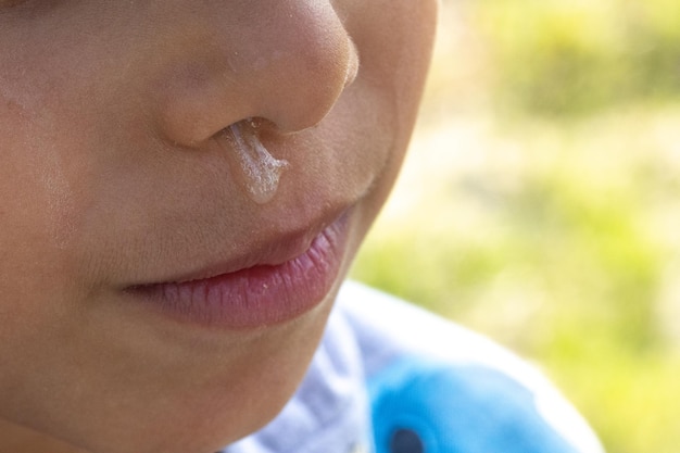 Photo details of a child's nose with mucus running down mucus due to cold or allergic rhinitis sick child not blowing his nose