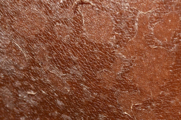 Details van de huid die afbladdert door zonnebrand