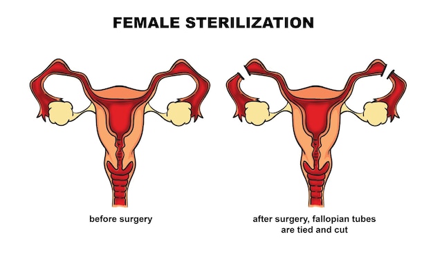 Digital illustration of female sterilization by tie cut fallopian tubes procedure health medical