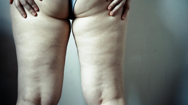 Dij van een vrouw met cellulitis Figuurprobleem cosmetische massage Een meisje met overgewicht masseert haar been met haar handen en controleert op cellulitis
