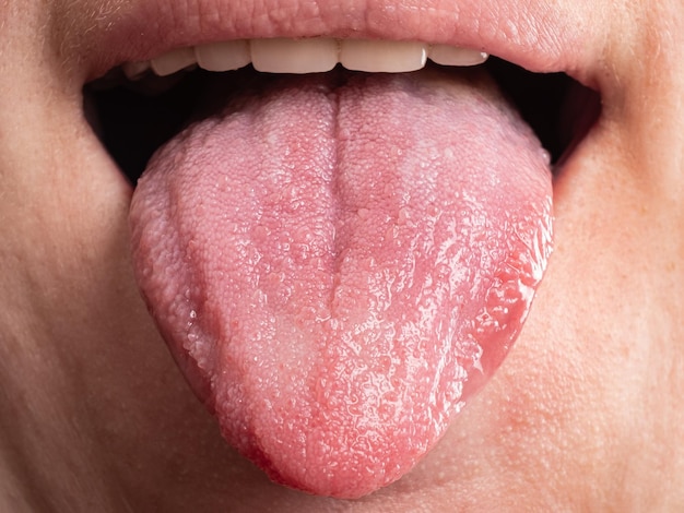 Diseases of the oral cavity tongue infections cancer