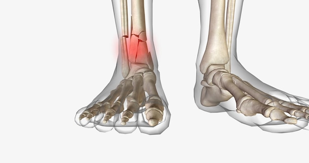 Distal tibia fractures affect the ankle joint and can often involve a fracture of the fibula