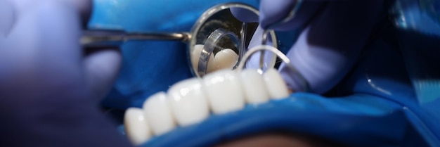Doctor dentist installing veneers on patient teeth using metal tools closeup