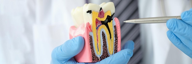 Doctor dentist showing pen on carious cavity on artificial plastic model of tooth closeup