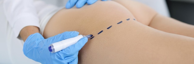 Doctor draws marks on the patients buttocks with marker for body shaping