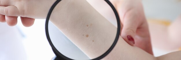 Foto il medico esamina la mano con le talpe tramite la lente d'ingrandimento. malattie della pelle e concetto di prevenzione