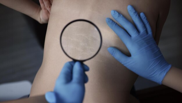 Photo doctor examining stretch marks on patients back using magnifying glass closeup