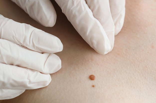 doctor examining woman39s mole in clinic closeup