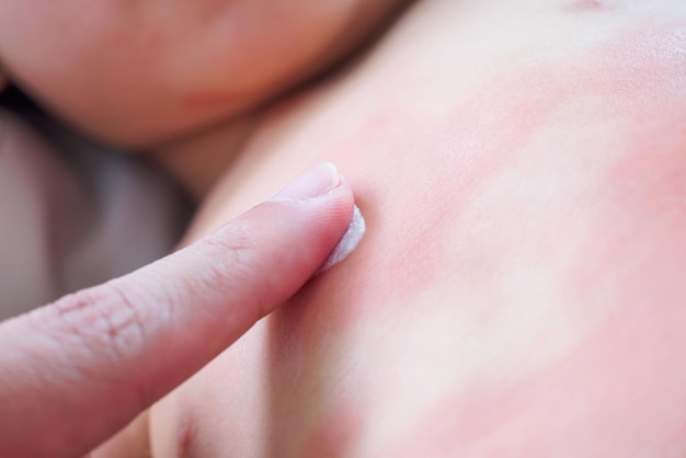 Doctor hand applying topical antihistamine medicine cream on little girl body with severe skin rash and allergy