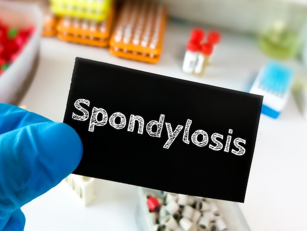 Photo doctor holding card with medical term spondylosis on laboratory background.