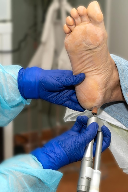 A doctor is using a syringe to remove the heel from a patient's foot