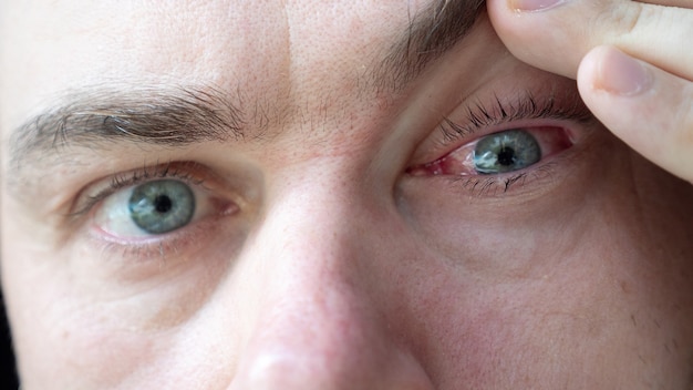 Doctor looks at male patient with red inflamed eyes with conjunctivitis