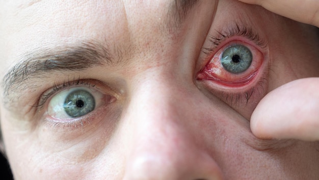 Photo doctor looks at male patient with red inflamed eyes with conjunctivitis