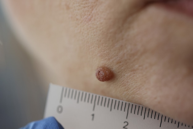 Doctor measuring size of patients pigmented nevus with ruler in clinic closeup