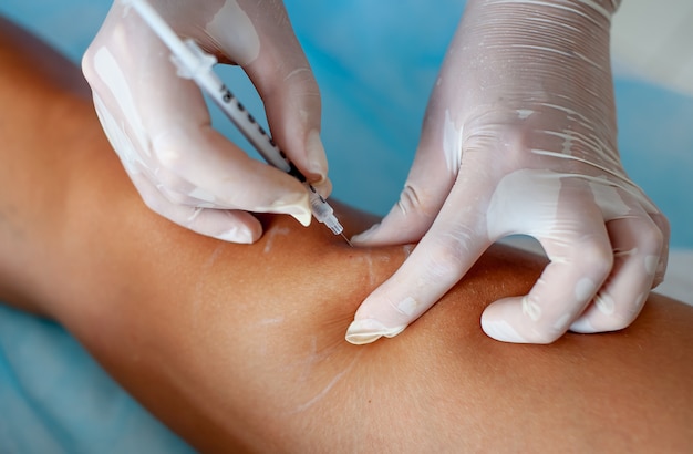 Doctor in medical gloves introduces sclerotherapy on woman's legs, close up